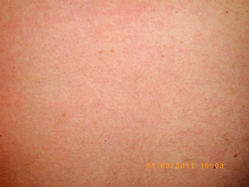 Red Rashes On Chest Pictures Photos