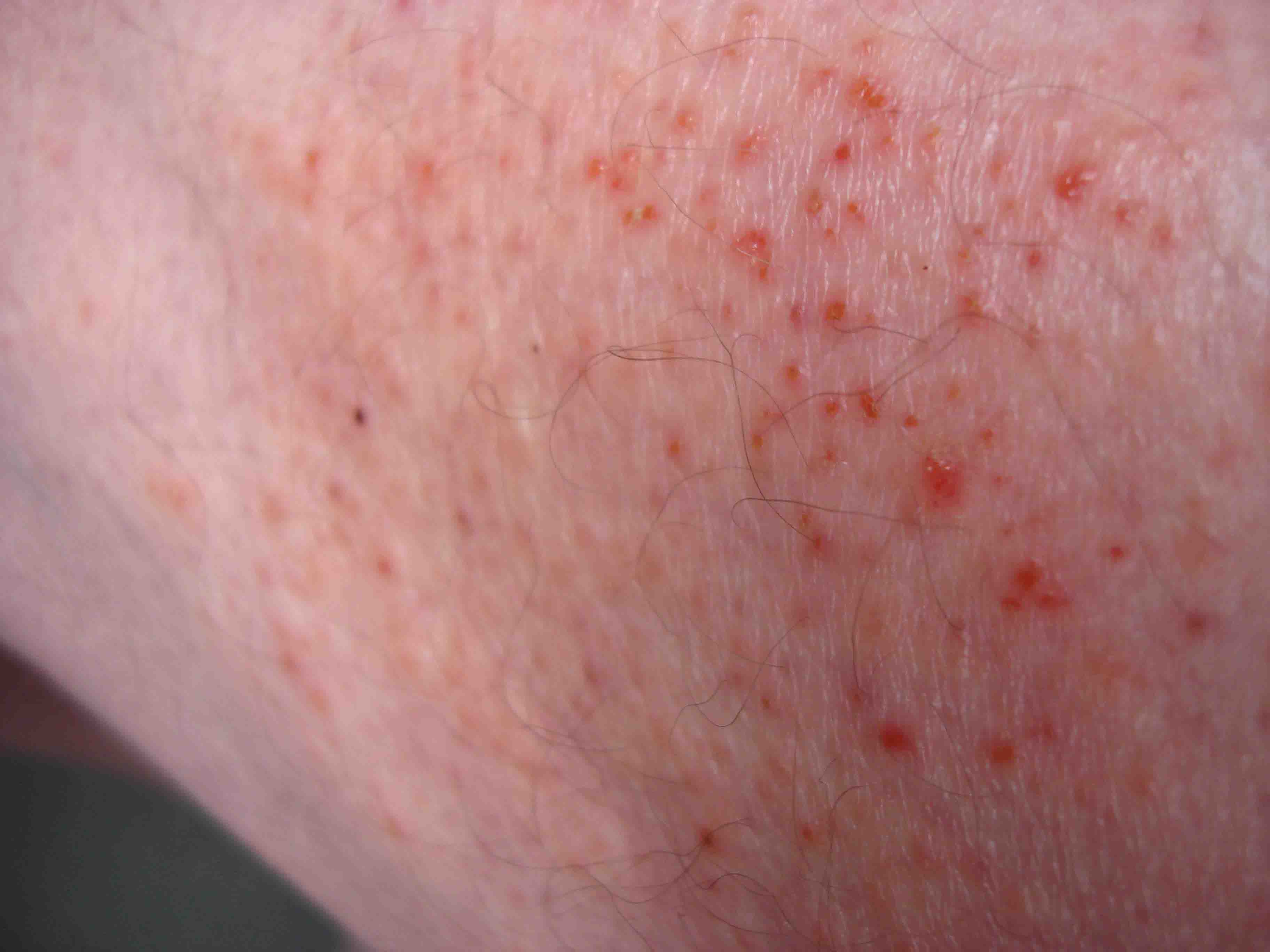 rash-on-whole-body-pictures-photos