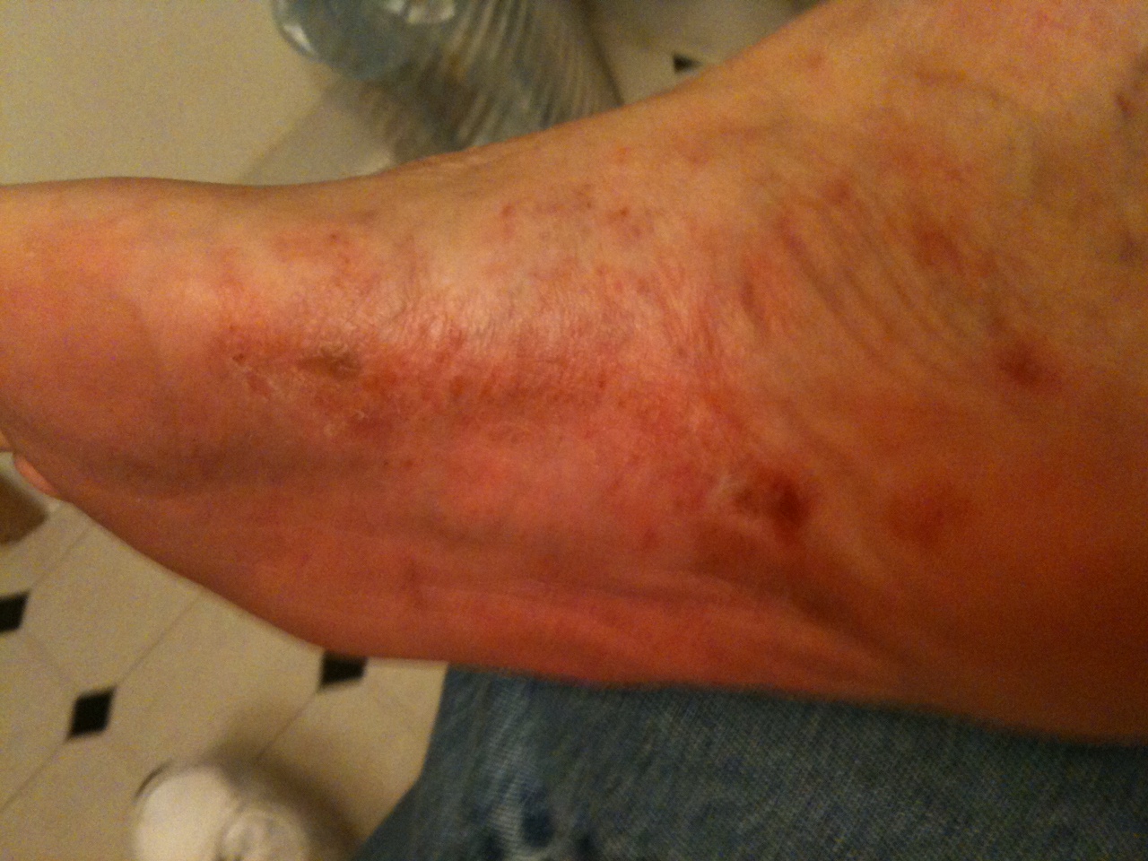 rash on bottom of foot pictures, photos
