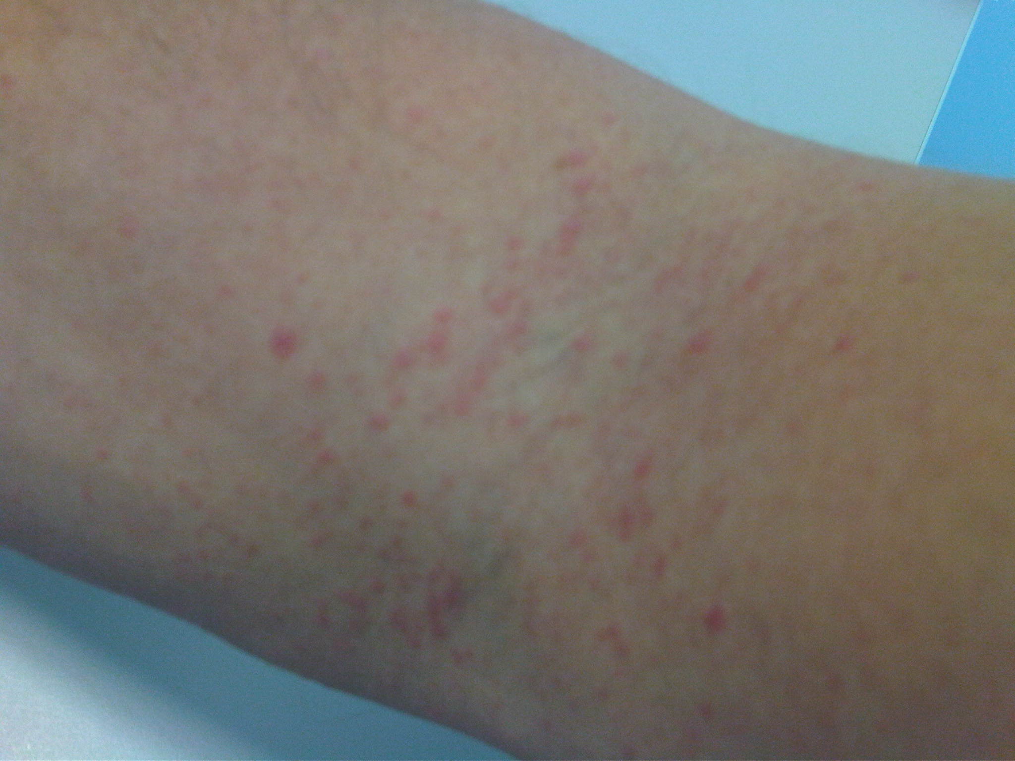 inner arm rash pictures, photos