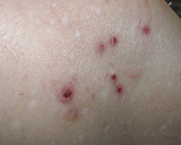 Raised Sores On Legs Pictures Photos