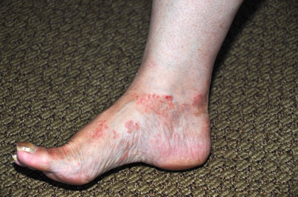 rash on side of foot pictures, photos