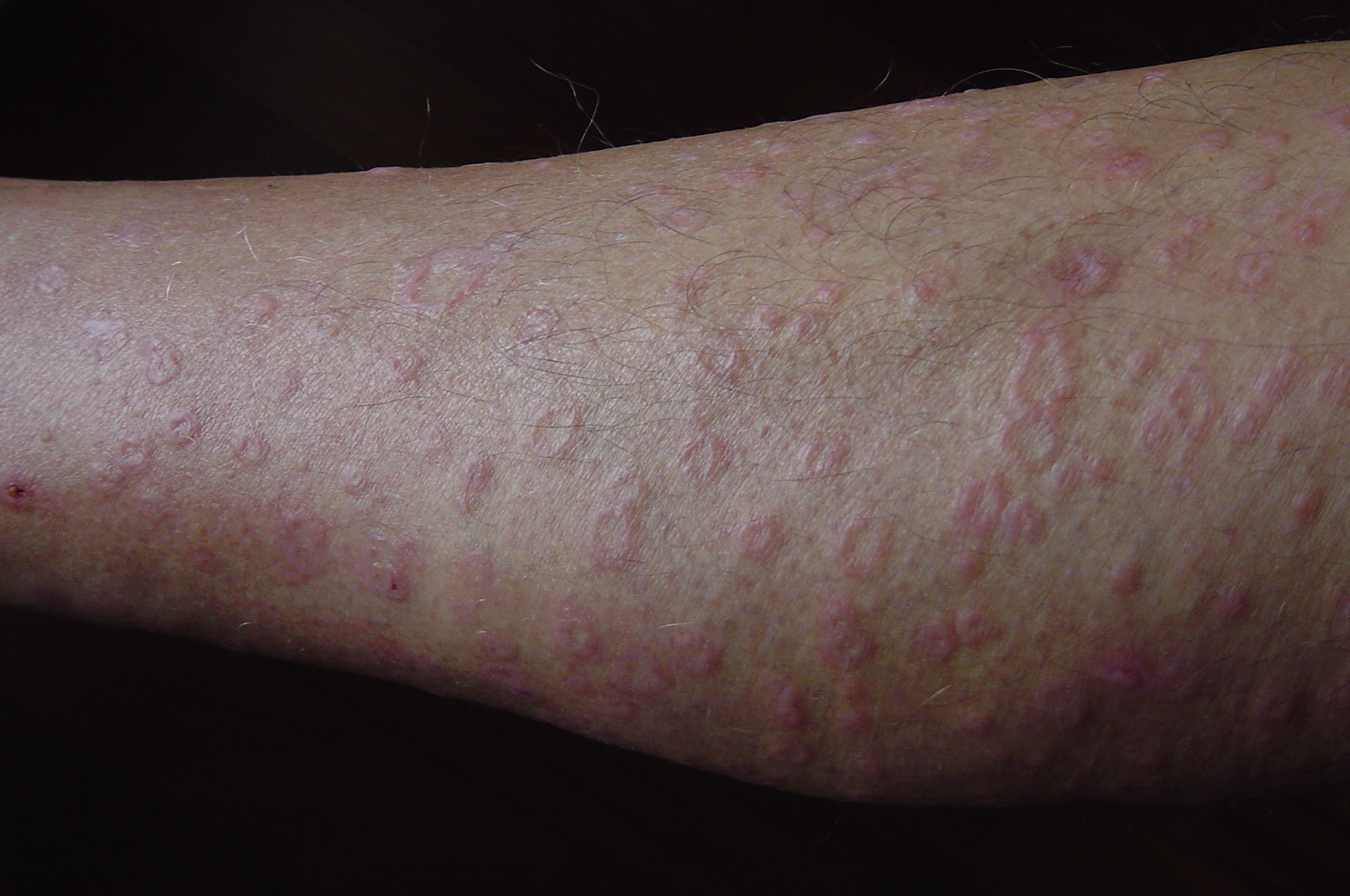 dermatitis on leg pictures, photos