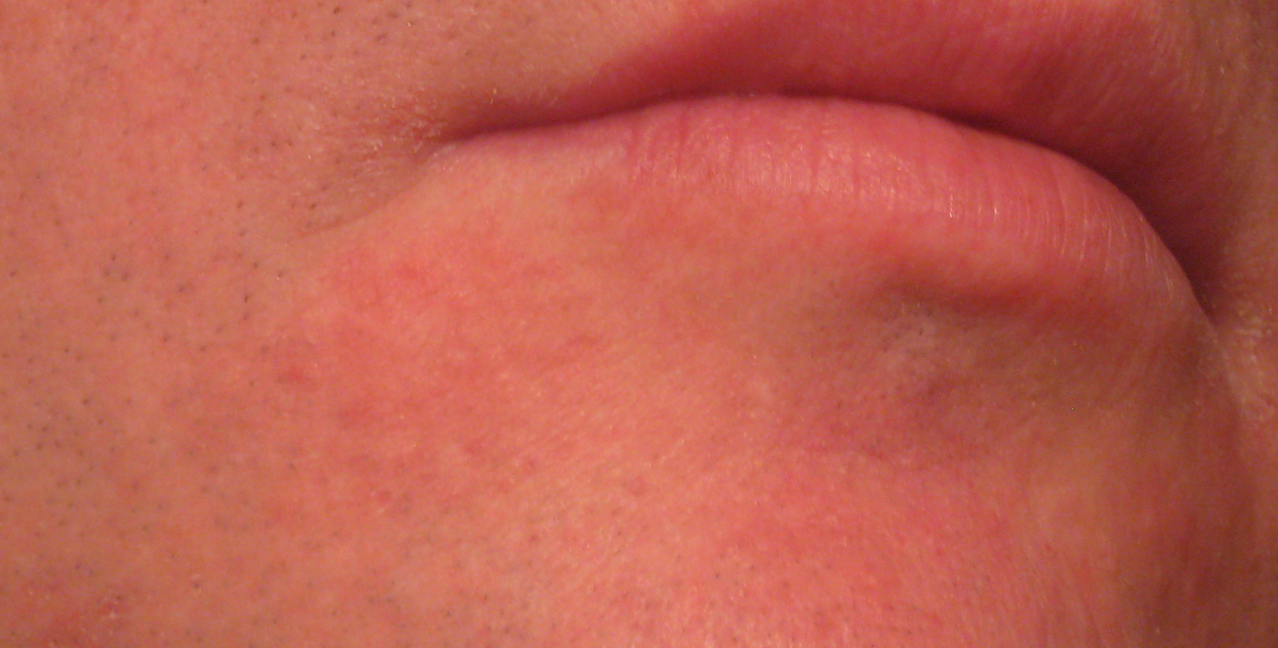 red rash on chin pictures, photos