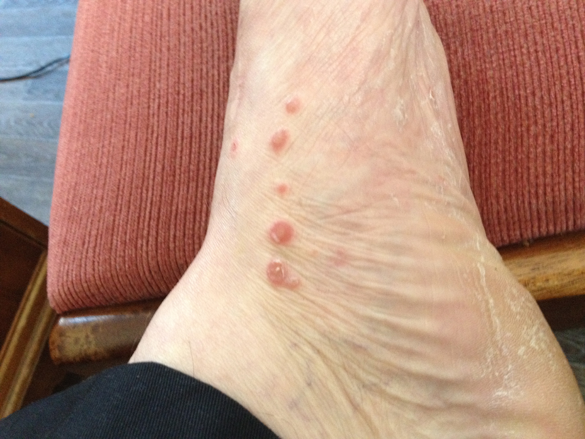 Red Marks On Foot