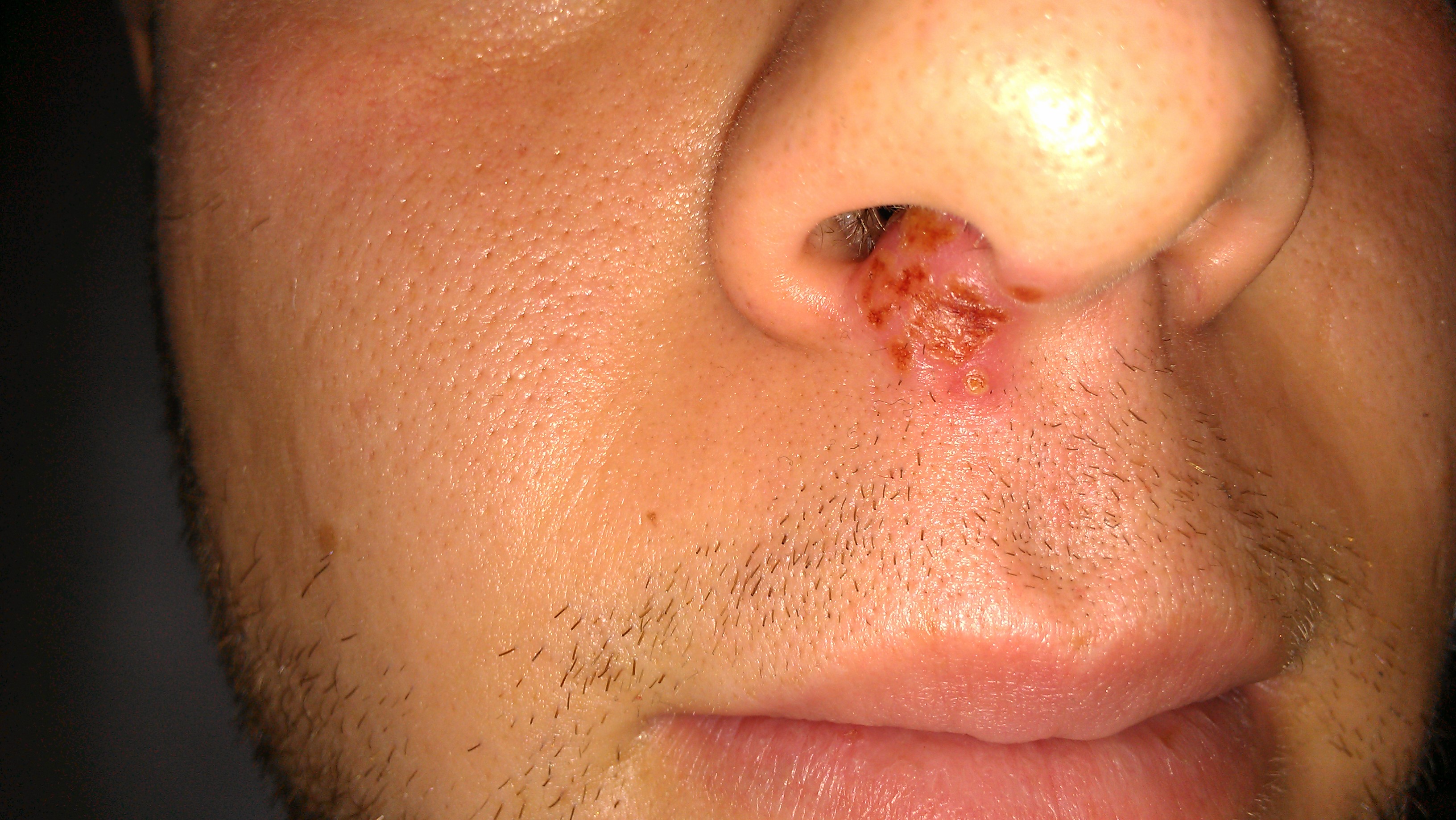 cold sore on nostril