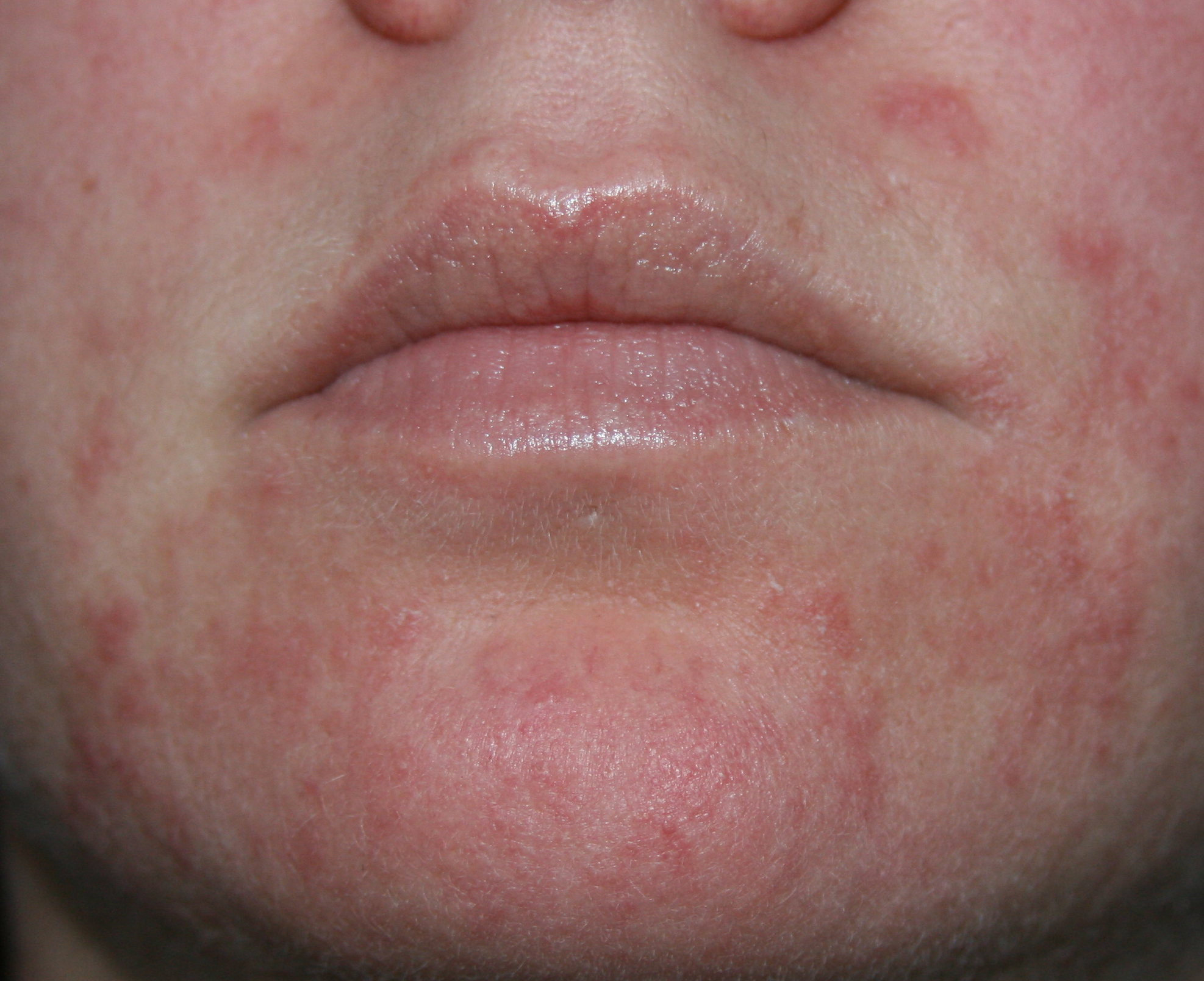 Skin Rash Itches Pictures Photos