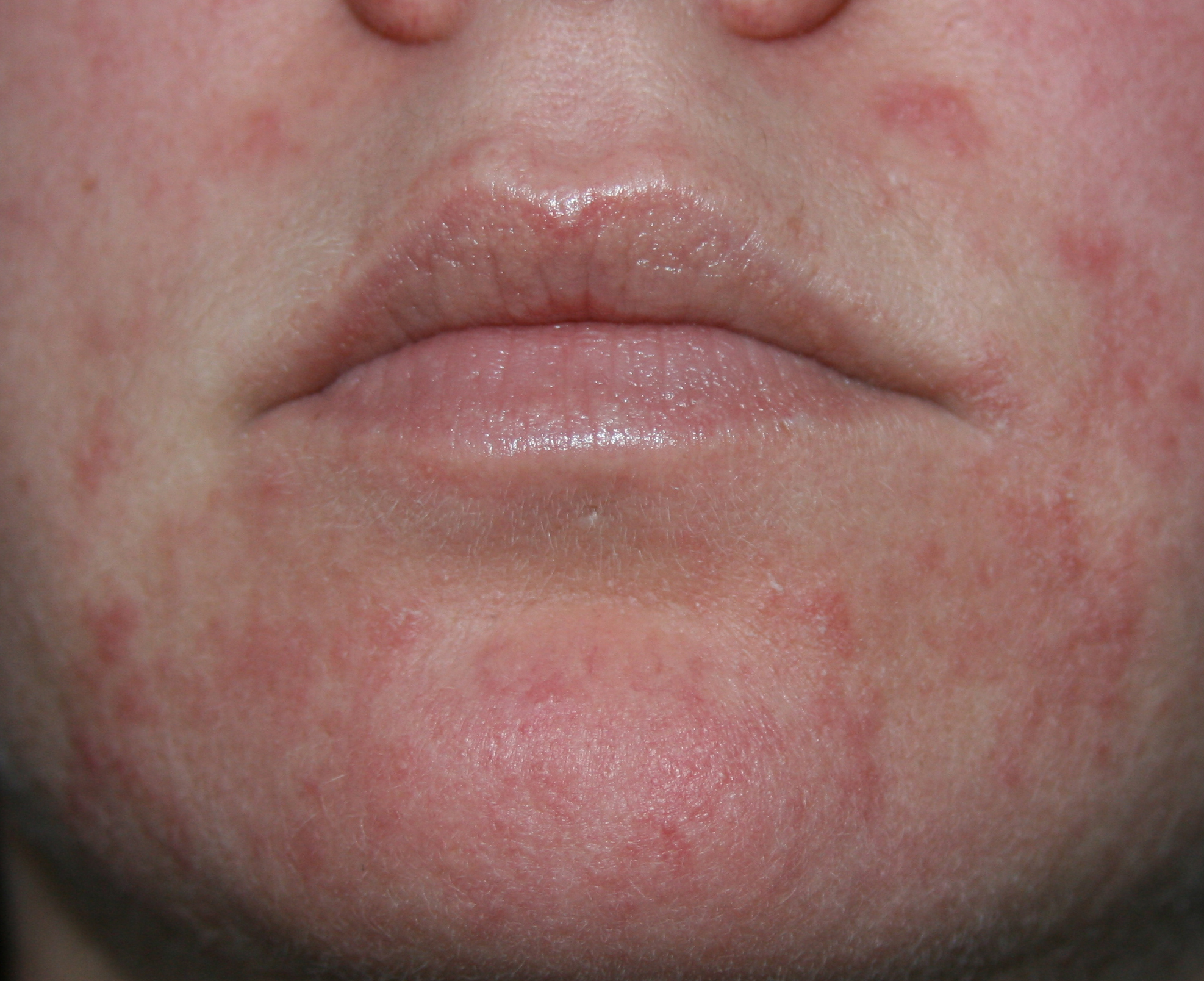 Can Stress Cause Itchy Rash On Face