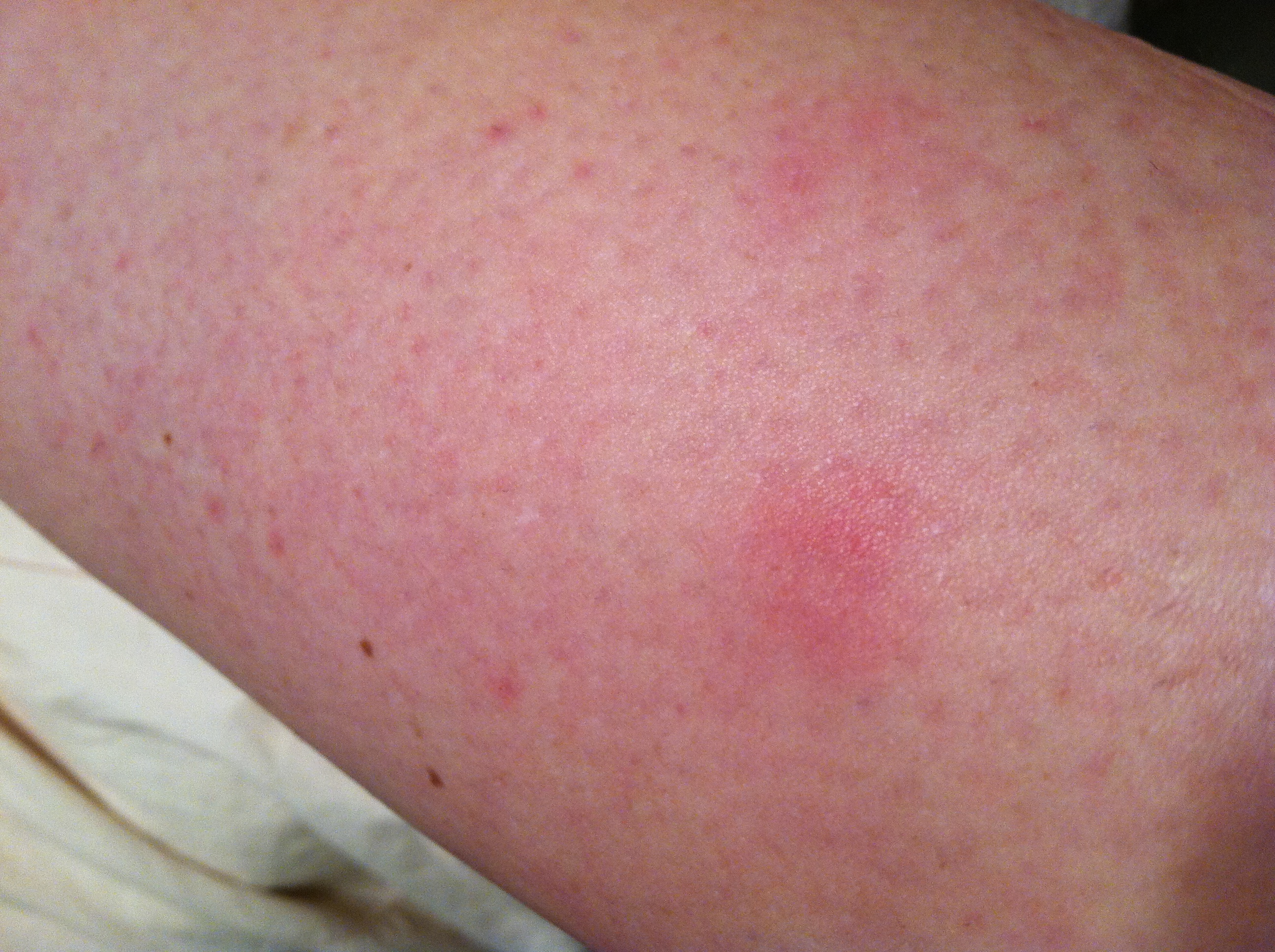 tiny pinpoint red spot on exposed skin