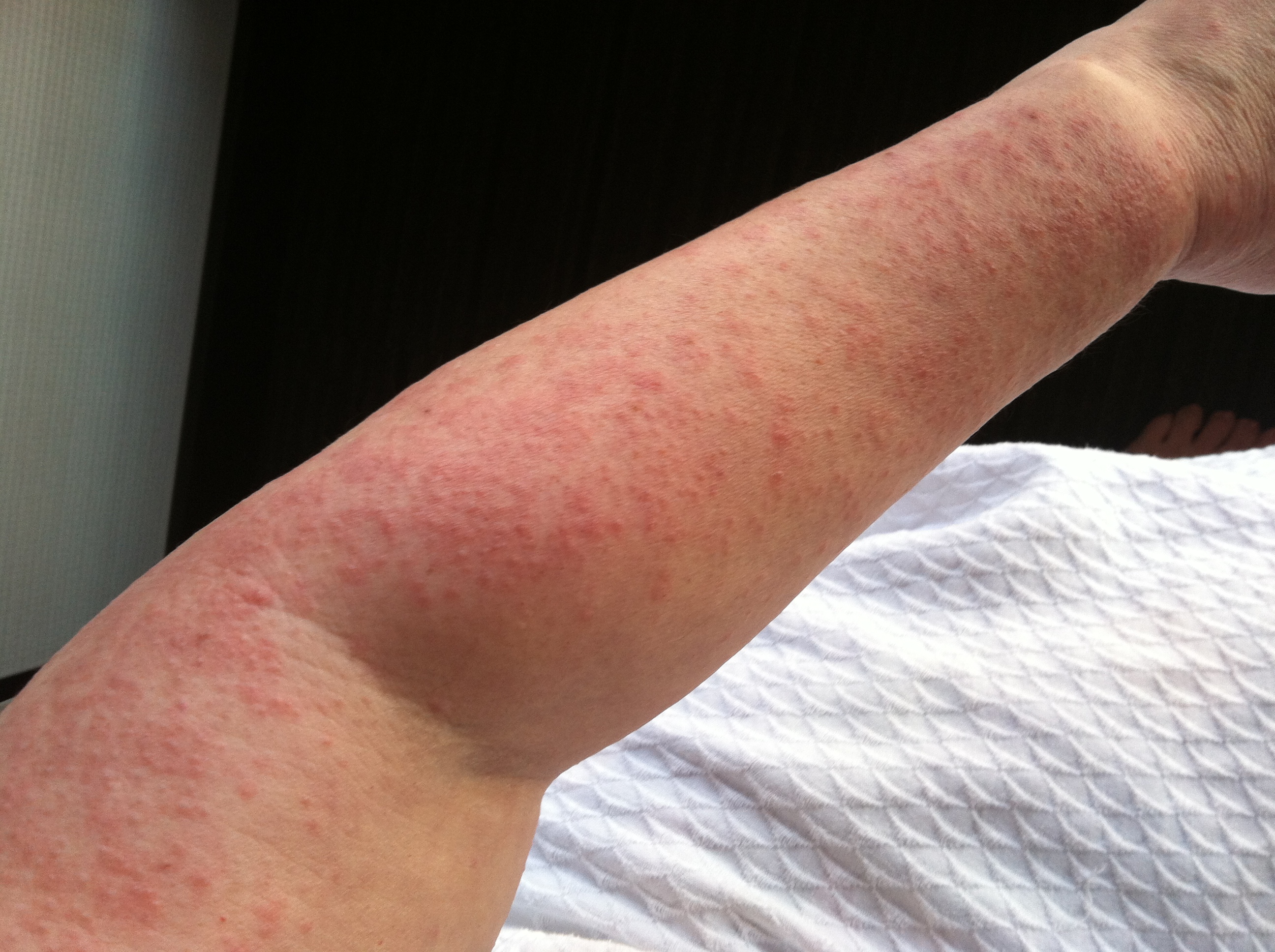 scabies rash pictures on legs - pictures, photos