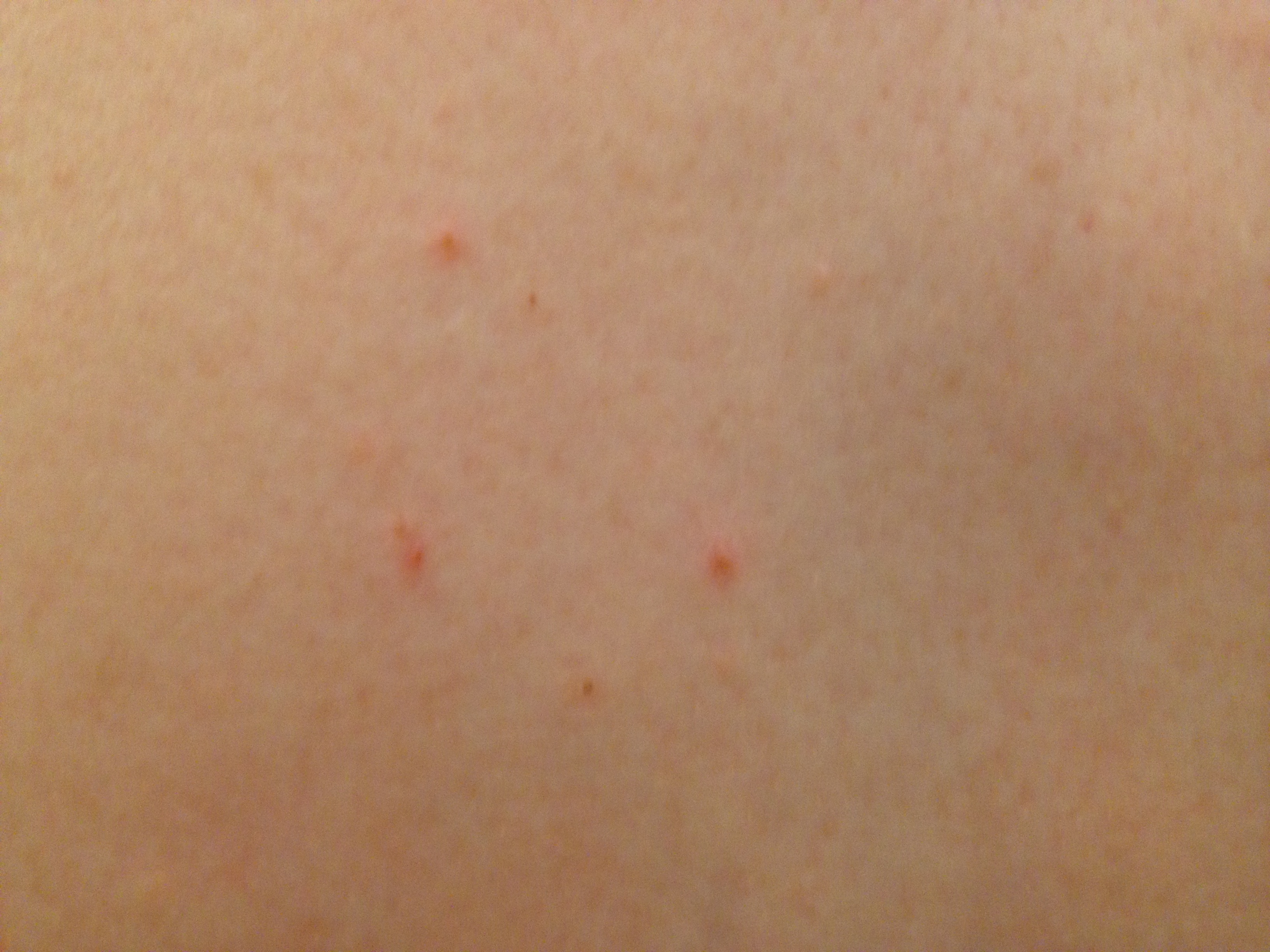 red-raised-itchy-bumps-on-skin-images-and-photos-finder-images-and