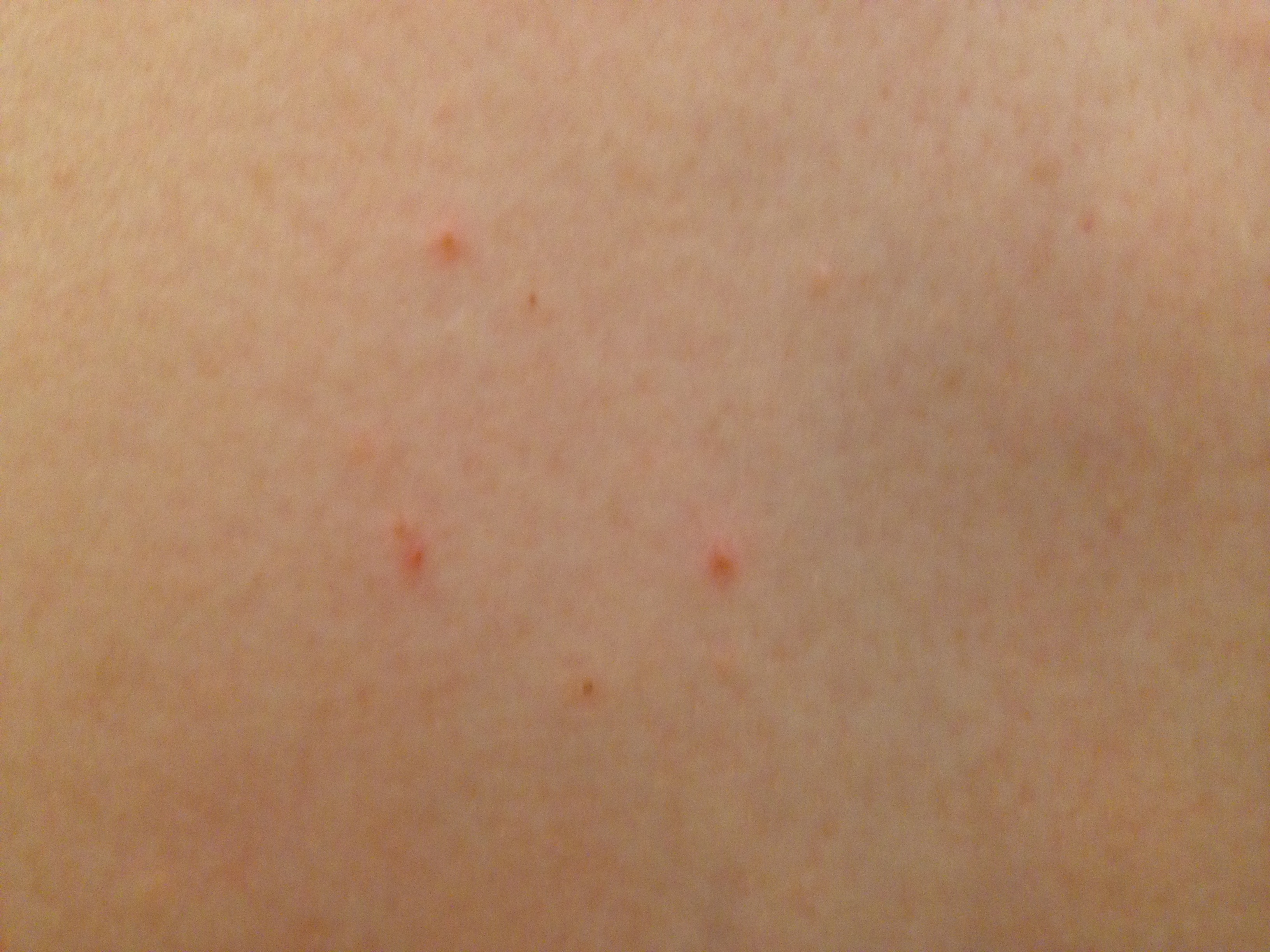 itchy bumps on body - pictures, photos