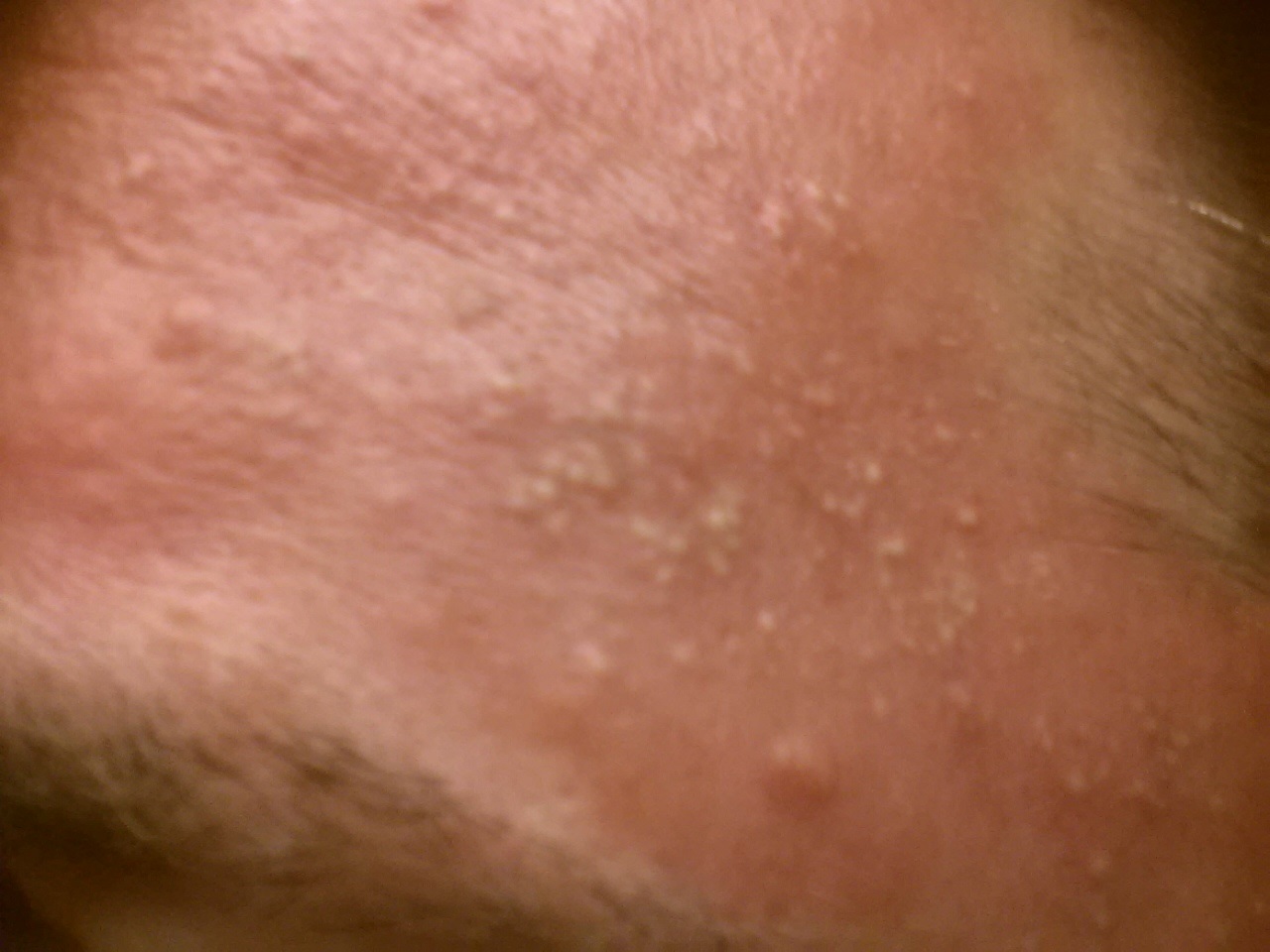 White Spots On Skin Go Away At Charles Gaylor Blog