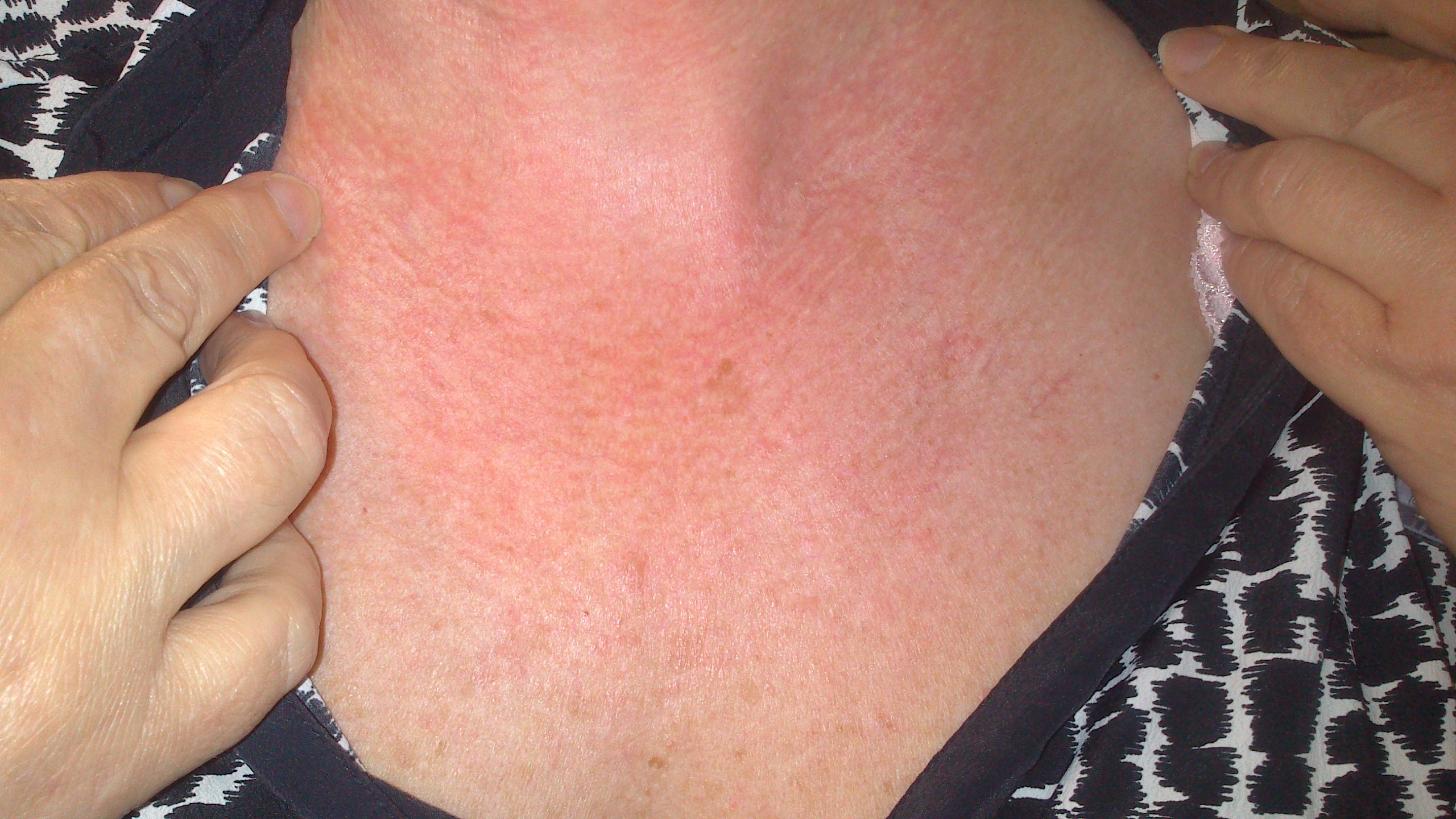 Neck And Chest Rash Pictures Photos