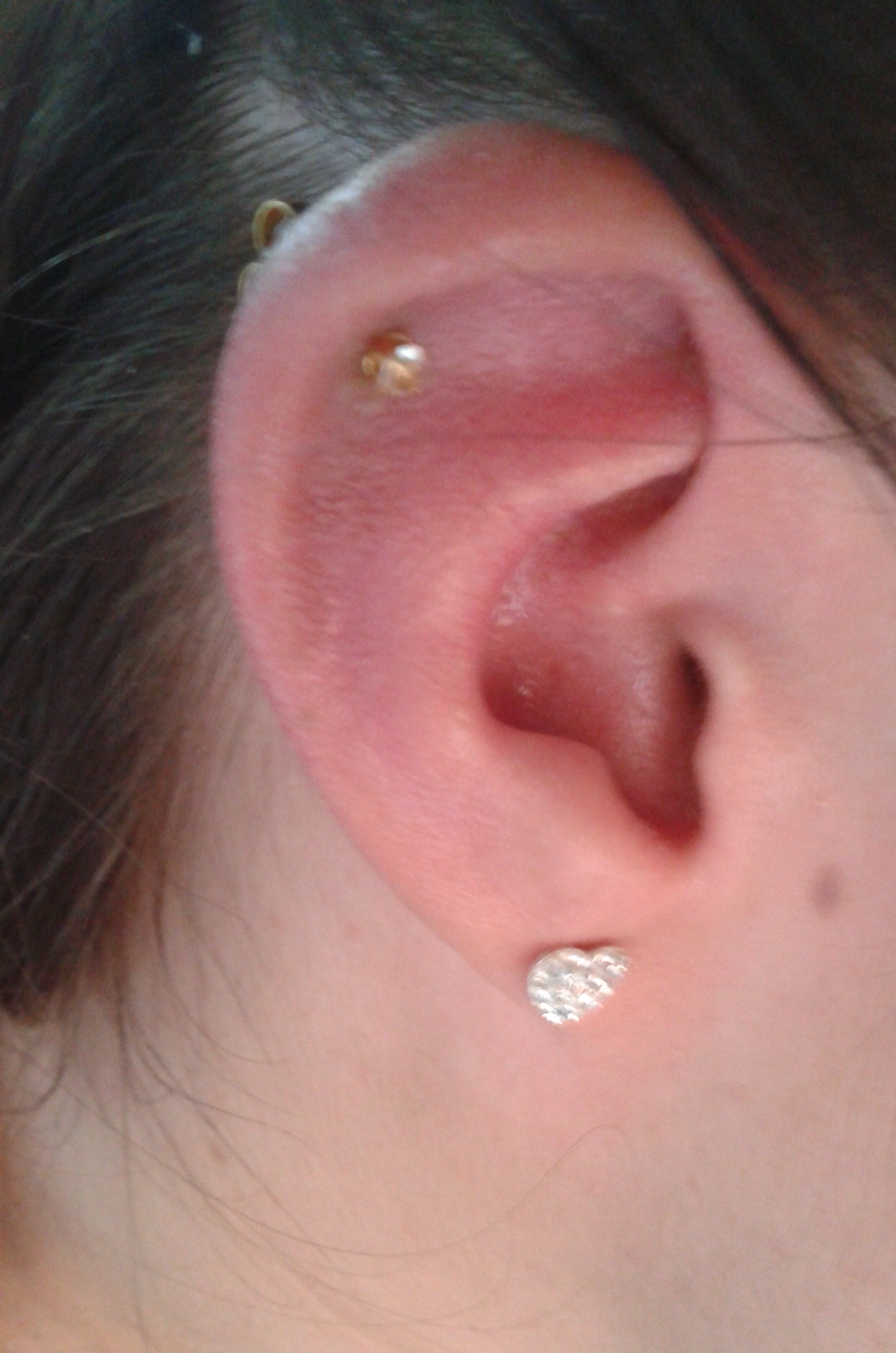 Swollen Ear Cartilage Pictures Photos