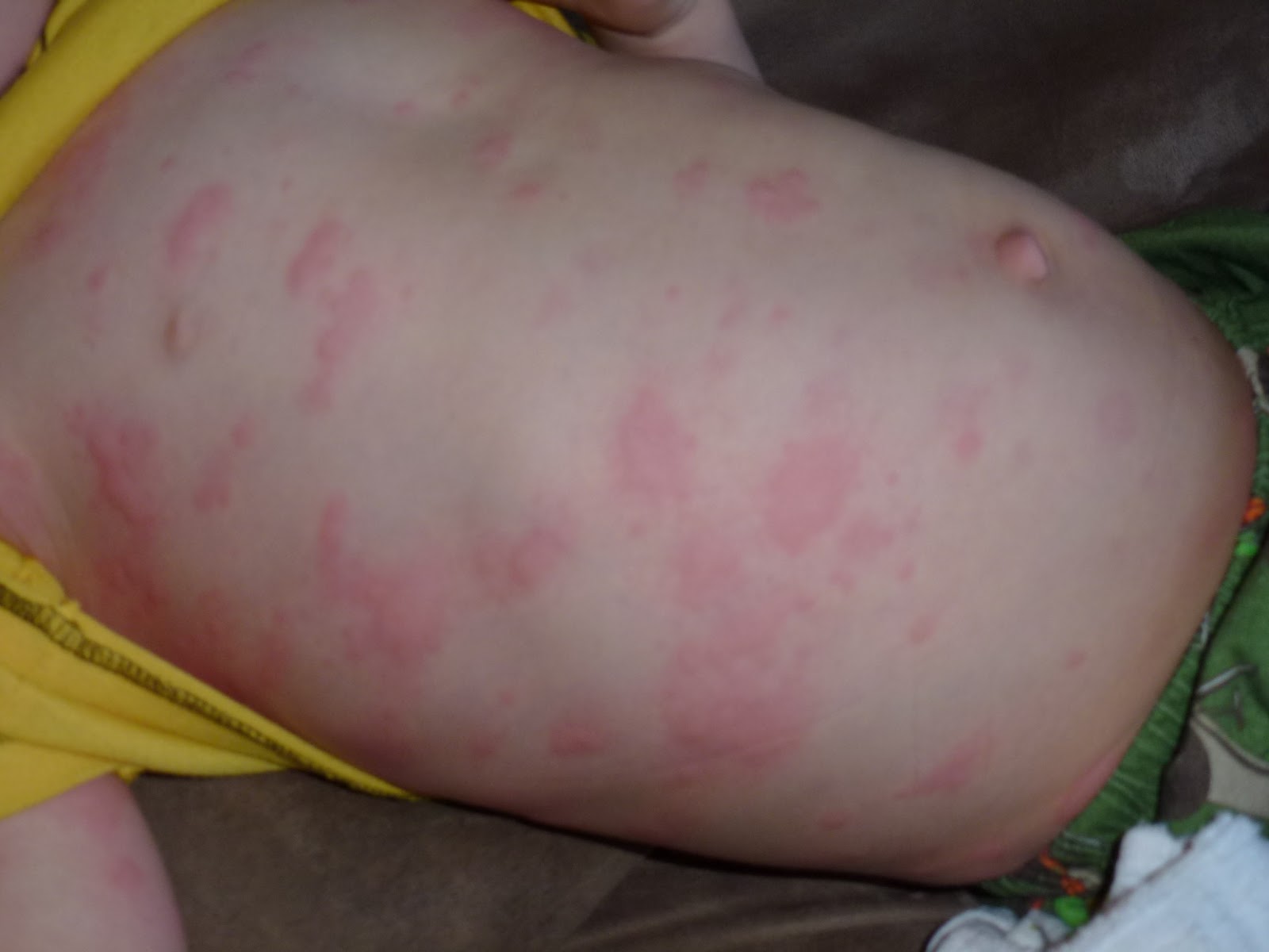 viral rashes in toddler - pictures, photos