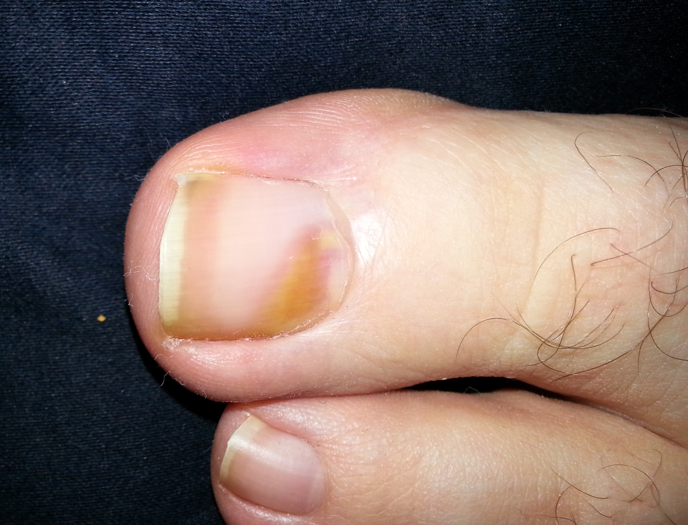 Black Lines Under Big Toe Nail