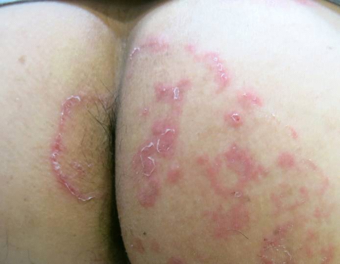 red rash on buttocks crack red rash on buttocks crack
