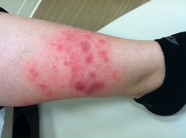itchy skin rash on legs pictures