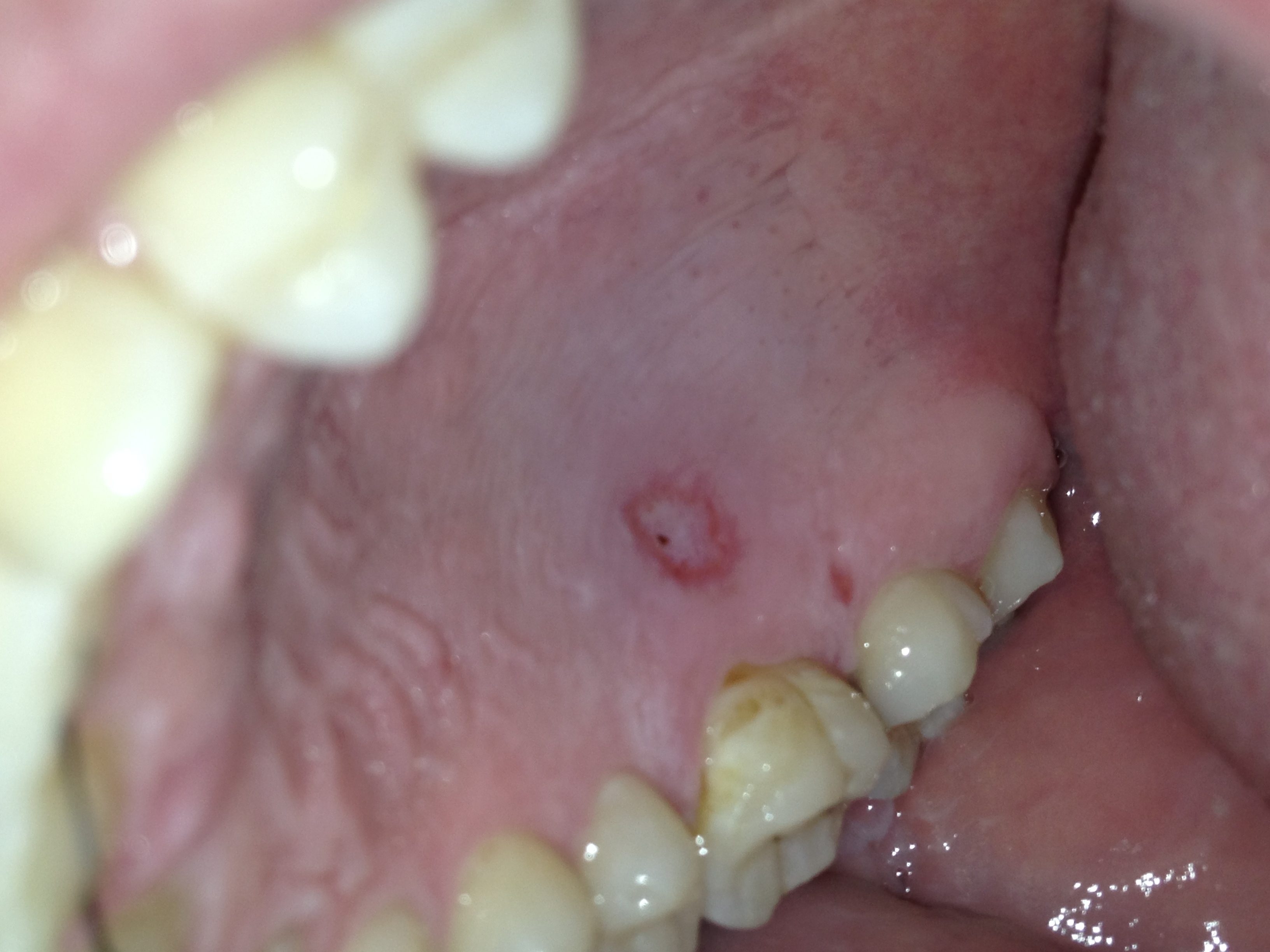 small black dot in mouth near tooth