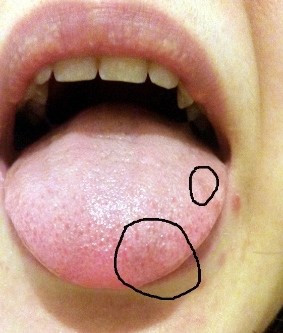 Why Do I Have A White Bump On My Tongue