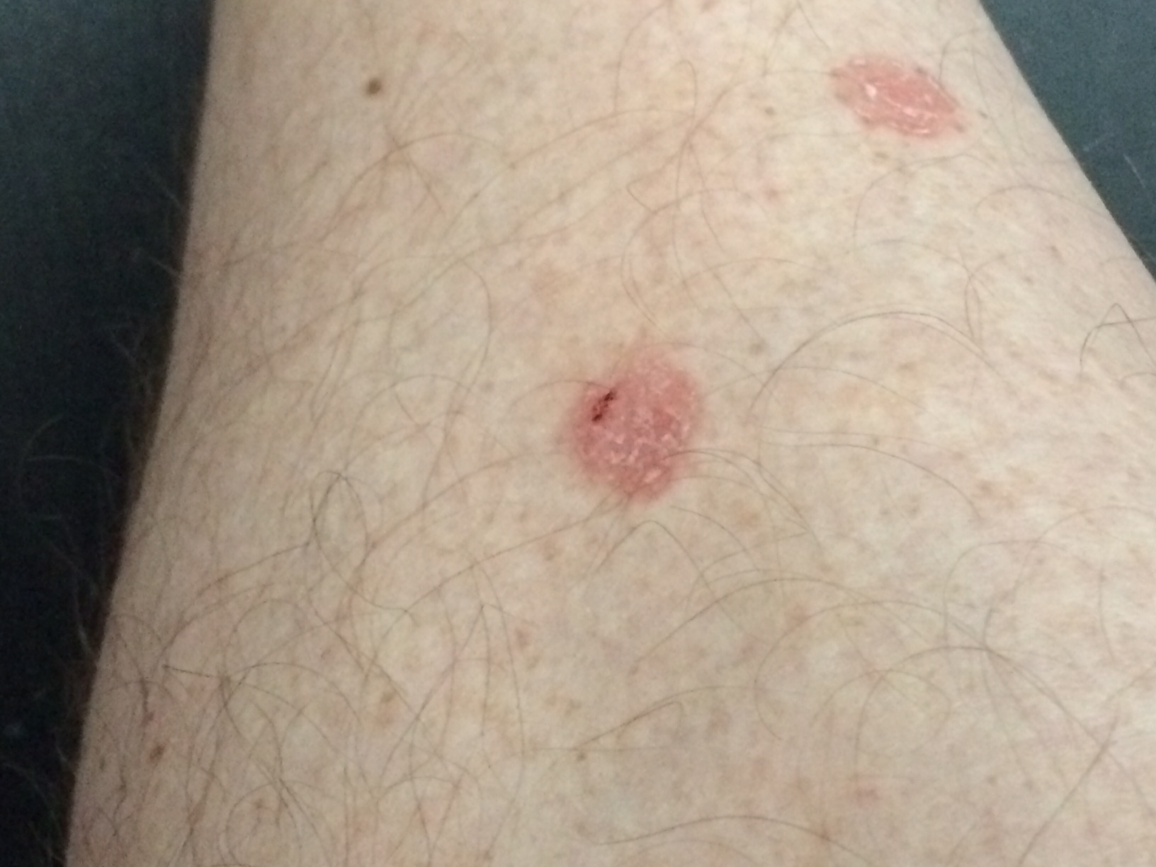 red circle on skin not itchy