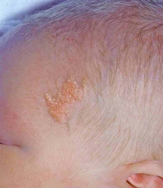 scalp-disorder-pictures-photos