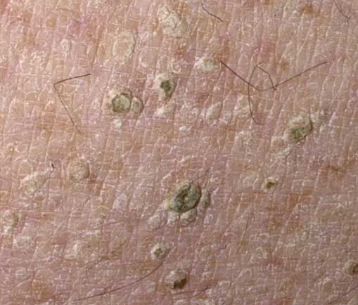 tiny-brown-spots-on-skin-pictures-photos