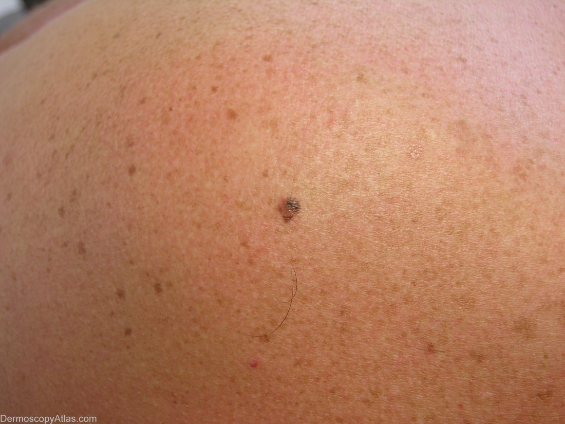 How Dangerous Is Melanoma On The Head