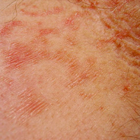 rheumatoid arthritis rashes - pictures, photos