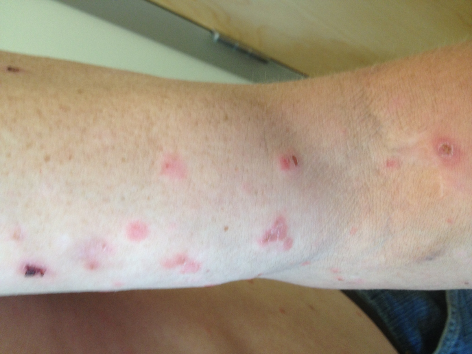 Itchy Lower Legs Rash Treatment