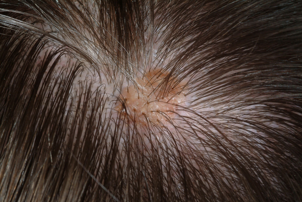 scalp conditions pictures - pictures, photos