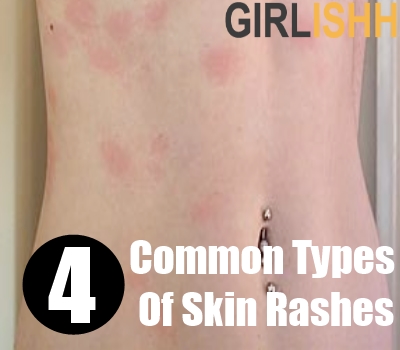 viruses that cause rashes - pictures, photos