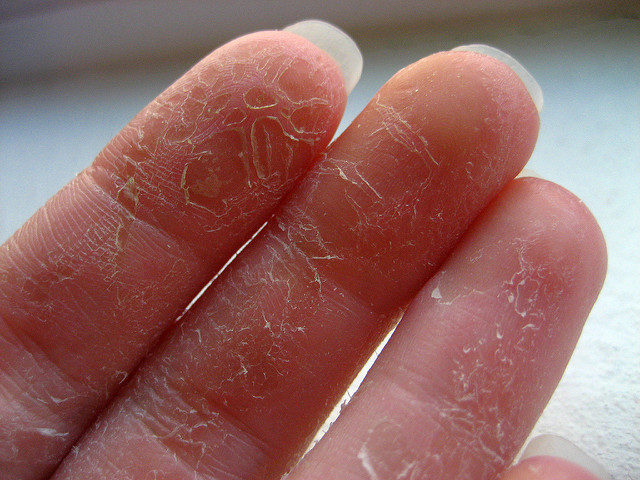 finger skin peeling