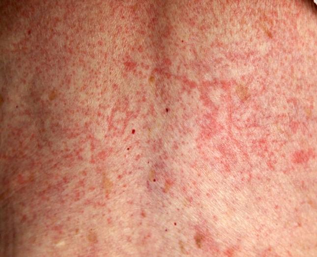 drug-allergy-rashes-pictures-pictures-photos