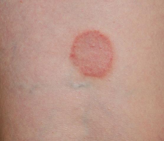 red-circles-rash-pictures-photos