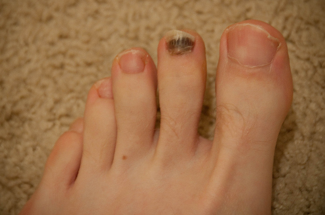 do-i-have-a-bruised-toenail-or-an-infection-sierra-foot-ankle