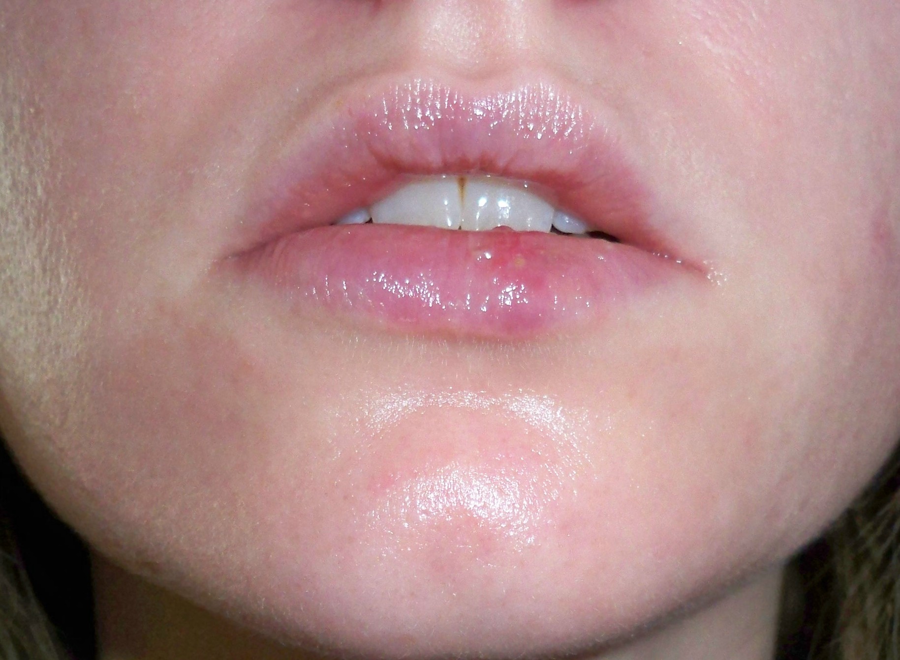 Bump On Inside Of Lip Pictures Photos