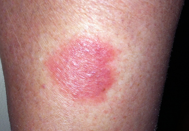 reaction to wasp sting icd 10