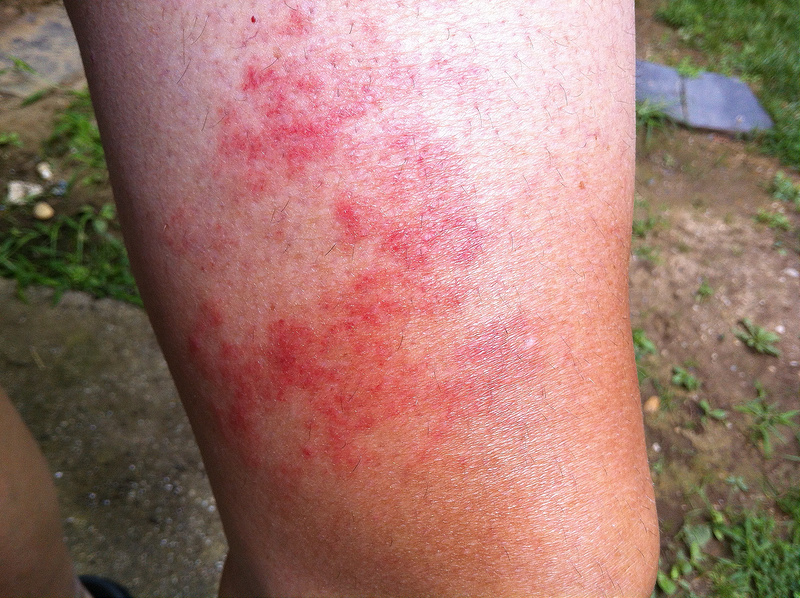 What Can Cause A Red Rash On Lower Legs