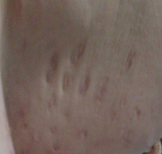 hidradenitis pictures - pictures, photos