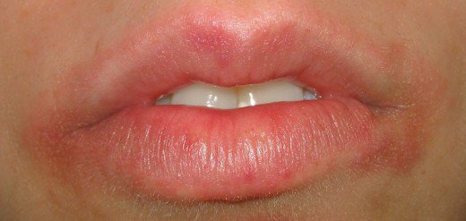 Rashes Around Nose And Mouth Pictures Photos