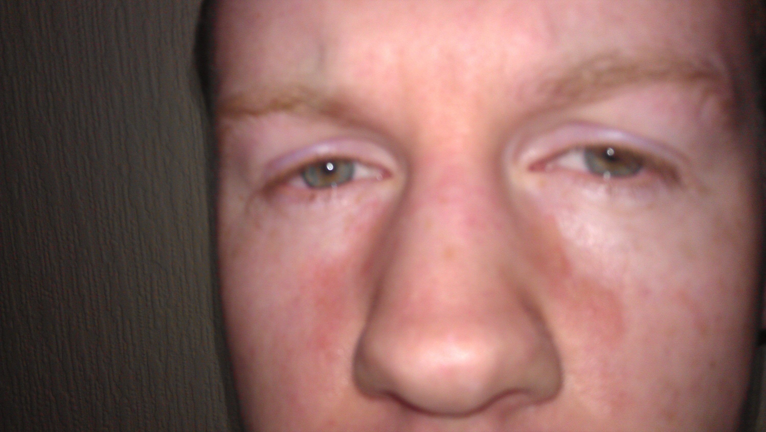 petechiae rash on face after crying torrent