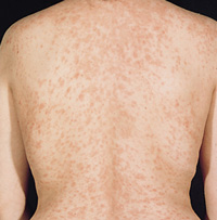 Pityriasis rosea - NHS