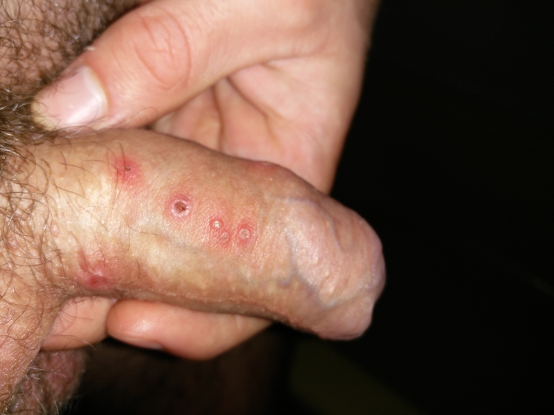 herpes blisters on penis - pictures, photos.