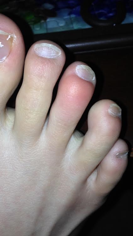 Painful Red Bump On Toe