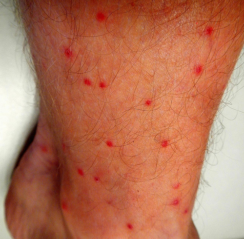 Red Dots On Ankles Pictures Photos