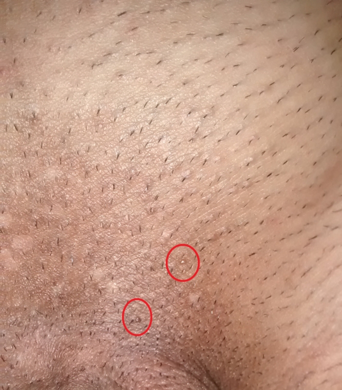 genital warts vs skin tags male