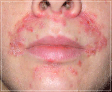 face rash around mouth - pictures, photos