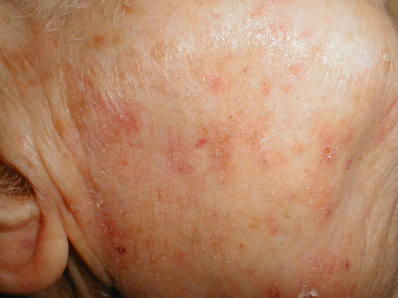 actinic-keratoses-pictures-pictures-photos